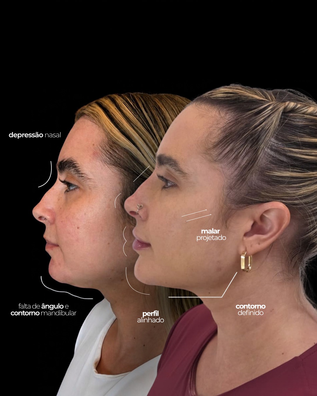 Comparativo de perfil facial com marcações de contorno mandibular, região malar e depressão nasal